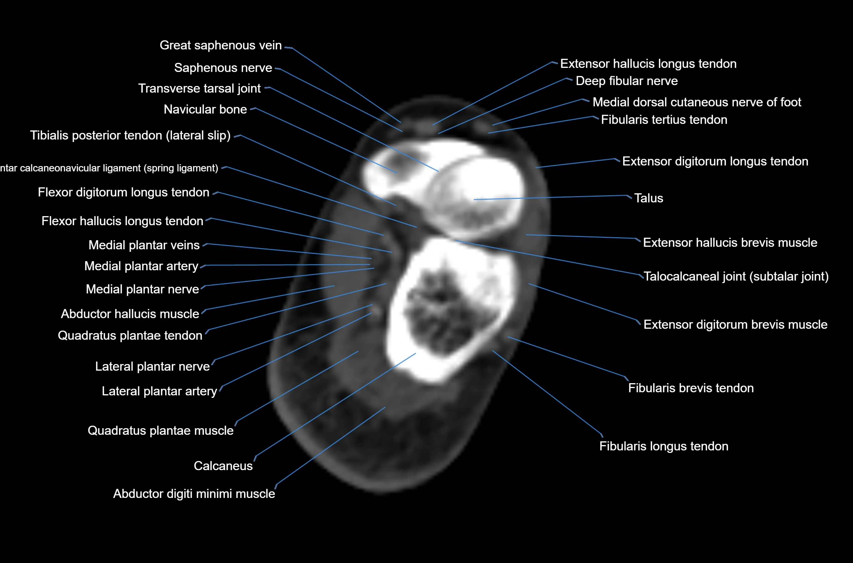 CT Ankle axial cross sectional anatomy labelled image -00043.webp